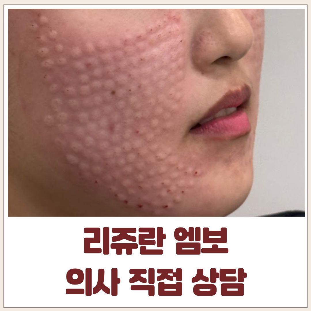리쥬란 엠보