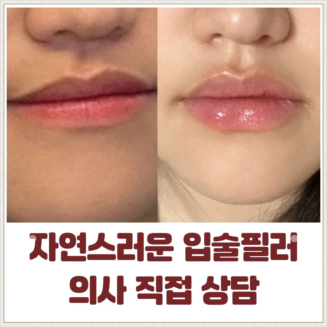 자연스러운 입술필러