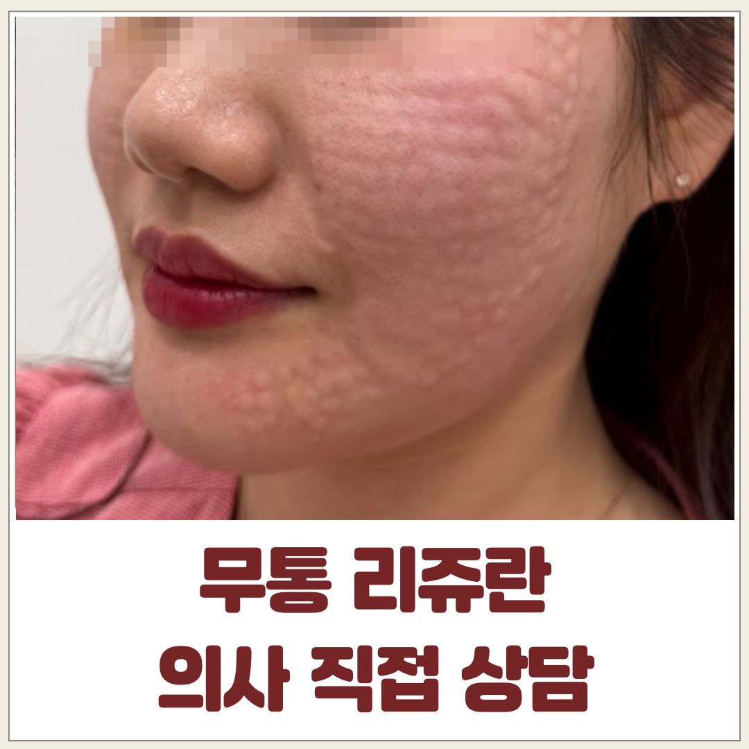 무통리쥬란