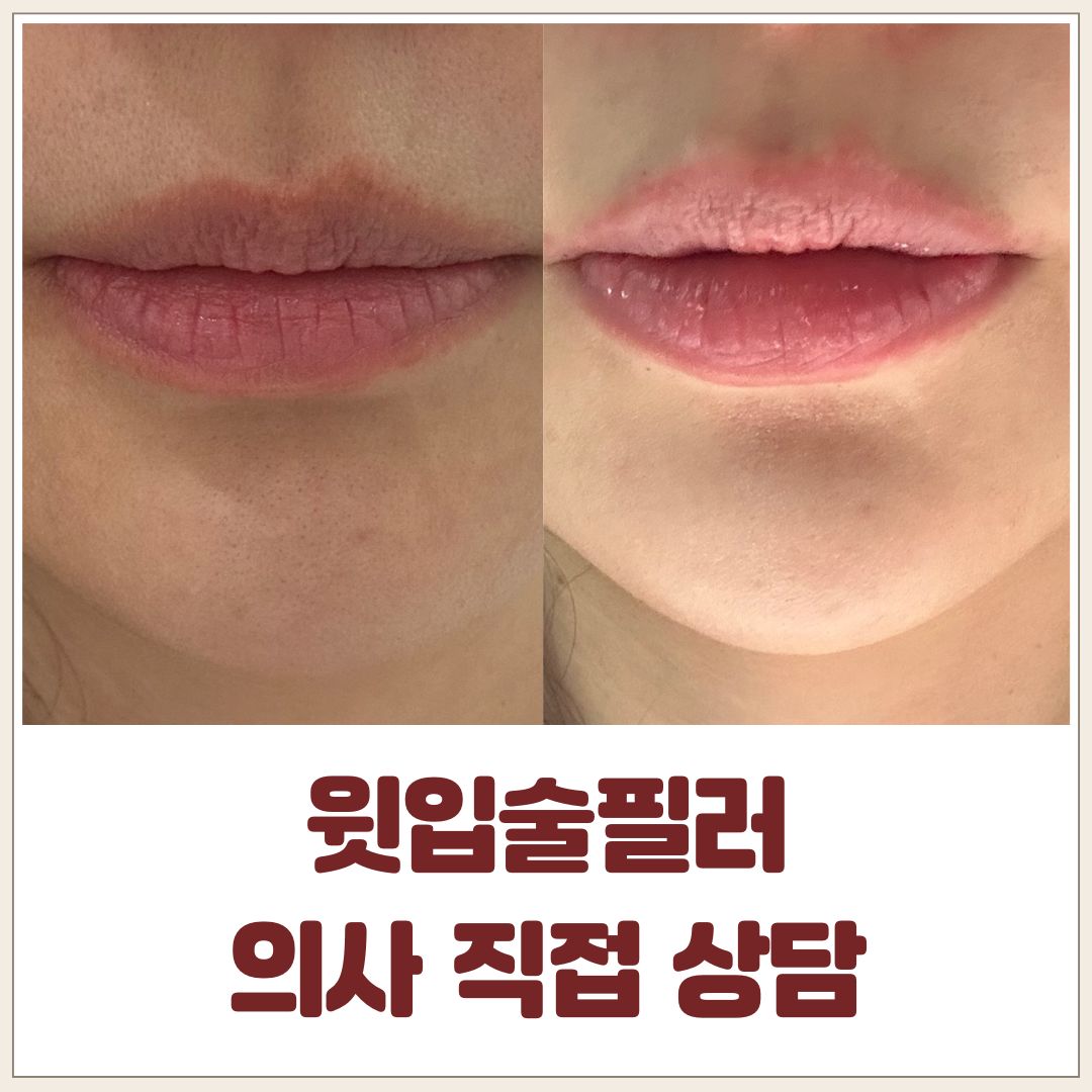 윗입술필러