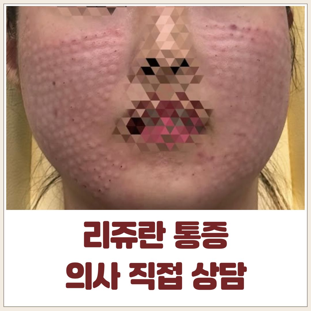 리쥬란통증
